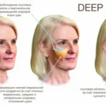SMAS Facelift vs Deep Plane Facelift